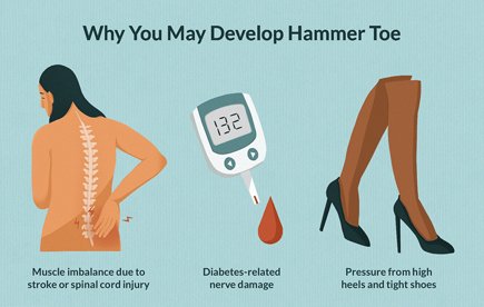 Hammertoe and Mallet Toe