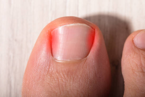 Symptoms of Ingrown Toenails