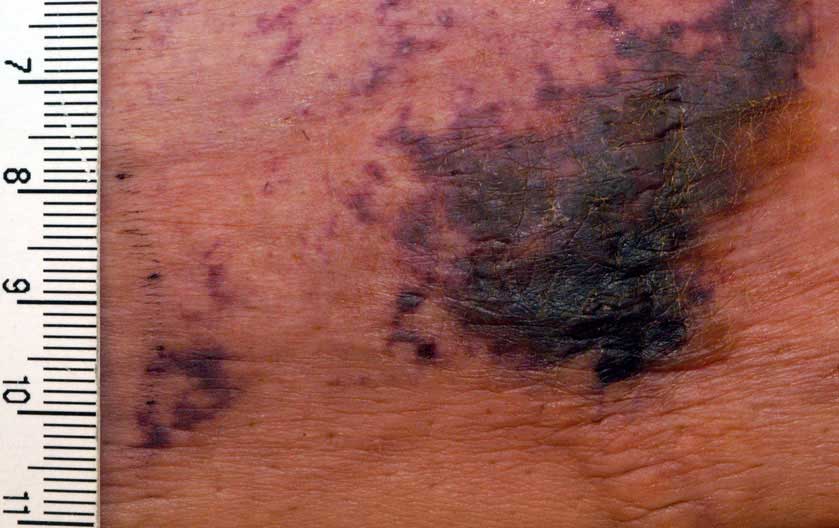 Calciphylaxis: Symptoms, Causes and Treatment