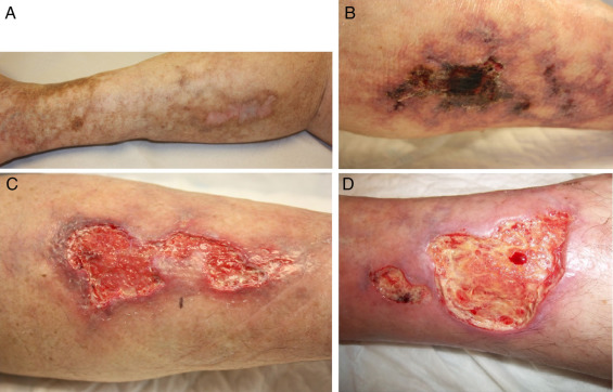calciphylaxis treatment