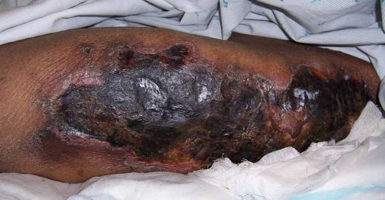 CALCIPHYLAXIS DIAGNOSIS