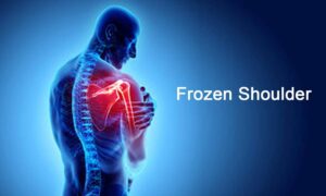 Frozen Shoulder: Symptoms, Causes and Treatment