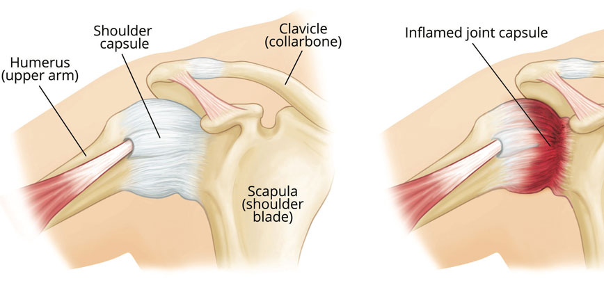 FROZEN SHOULDER CAUSES