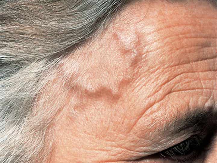 Giant Cell Arteritis: Symptoms, Causes and Treatment