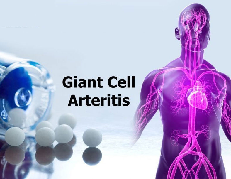 GIANT CELL ARTERITIS TREATMENT