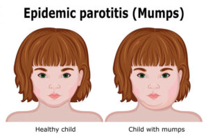 What is Mumps?