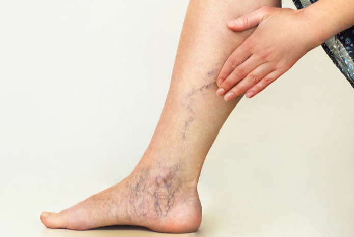 VASCULAR DISEASE CAUSES AND RISK FACTORS