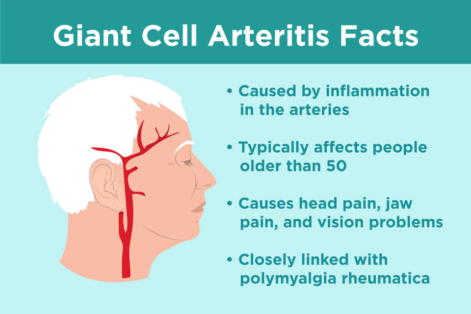 giant cell arteritis