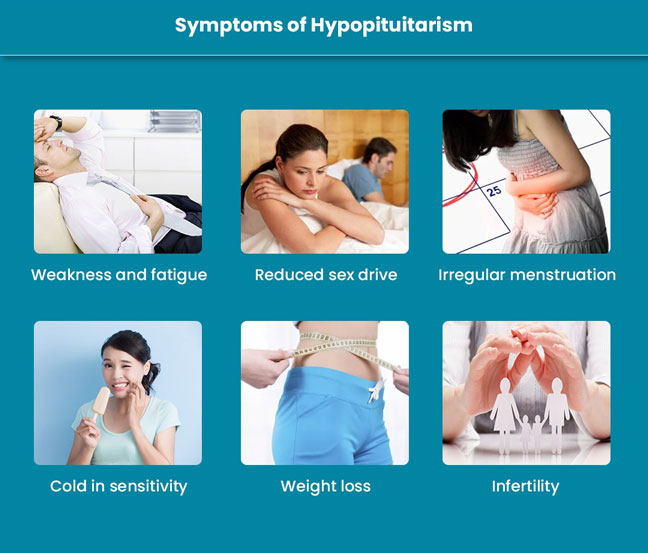 HYPOPITUITARISM SYMPTOMS