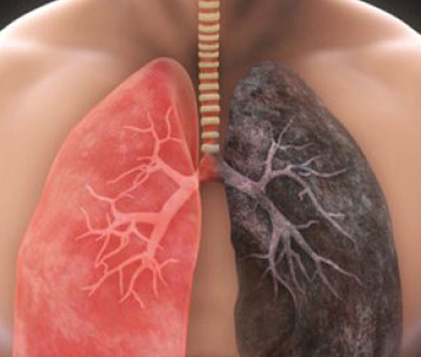 interstitial lung disease symptoms
