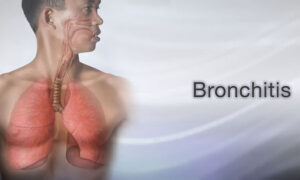 Discover the Symptoms, Treatments, and Causes of Bronchitis