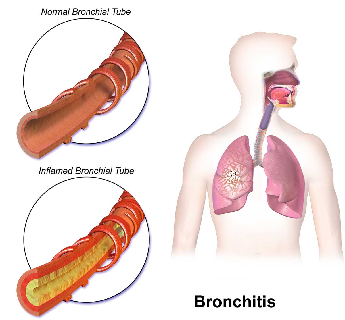 BRONCHITIS SYMPTOMS