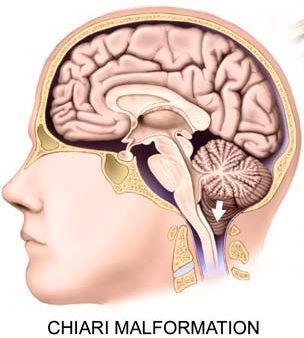 chiari malformations