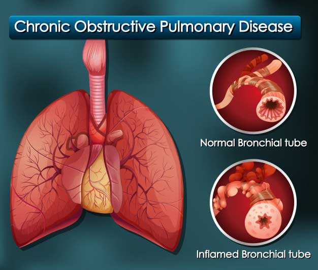 what is chronic obstructive pulmonary disease?