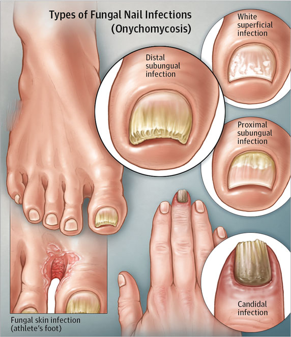 types of toenail fungus