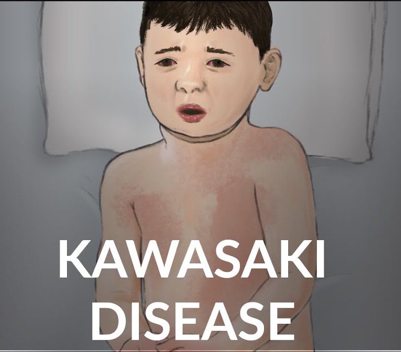 KAWASAKI DISEASE 