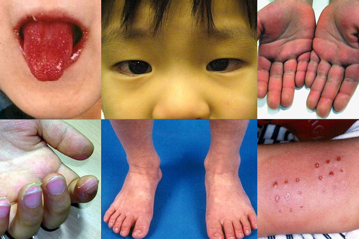 Exploring Kawasaki Disease: Symptoms, Causes, and Treatment