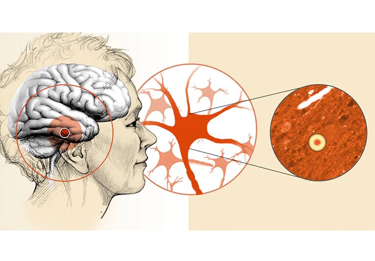 LEWY BODY DEMENTIA TREATMENT