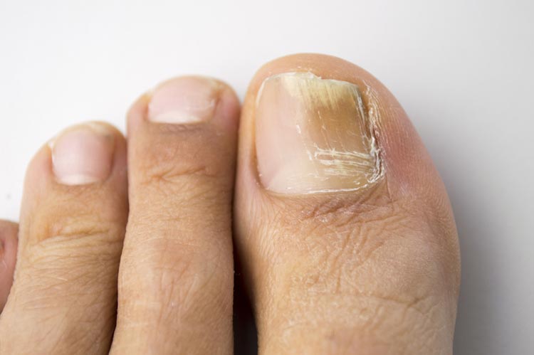 what causes nail fungus?