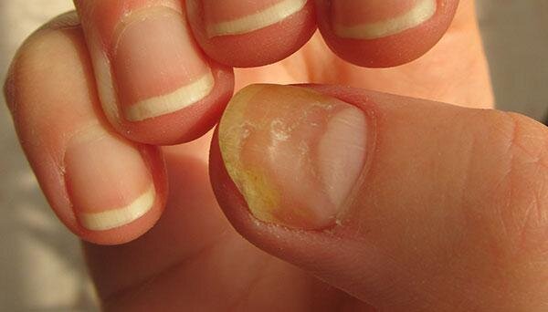 nail fungus treatment