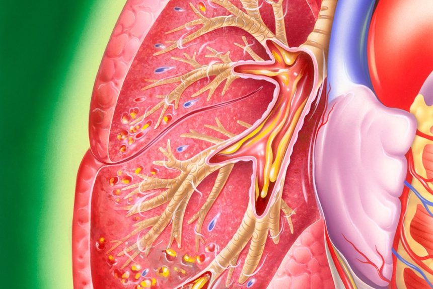 Chronic Obstructive Pulmonary Disease