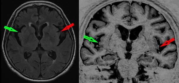 LEWY BODY DEMENTIA SYMPTOMS