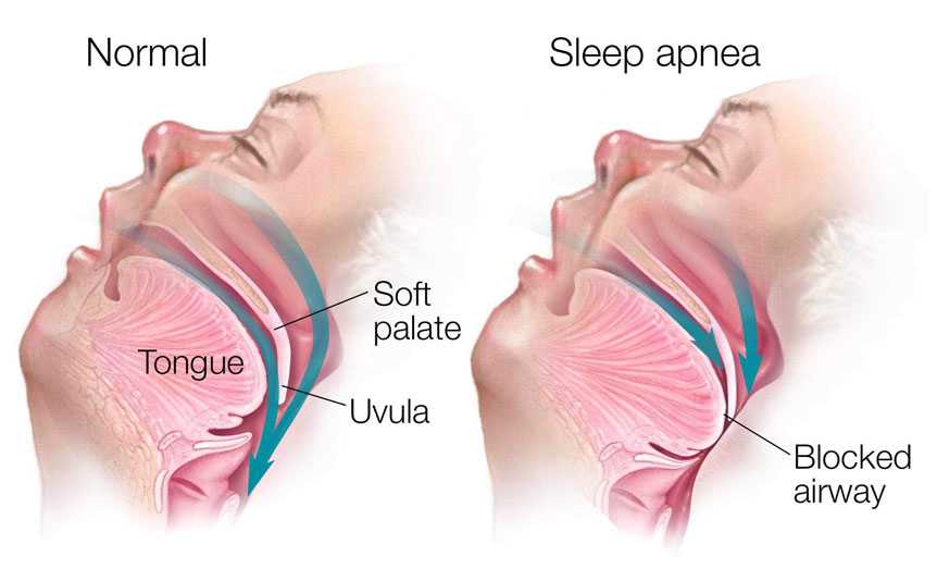 SLEEP APNEA