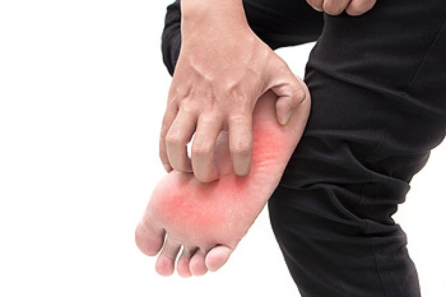 what is the cause of athlete's foot?