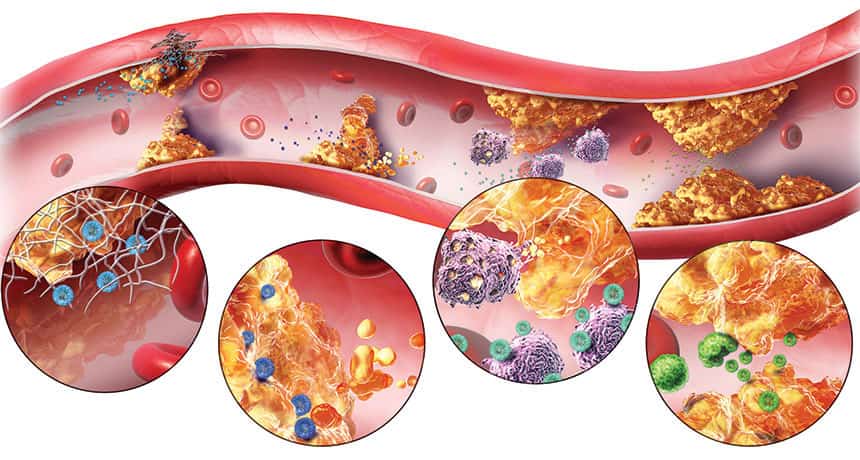 atherosclerosis symptoms