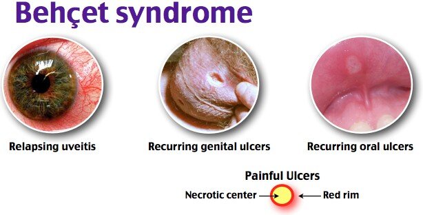 BEHCET’S SYNDROME