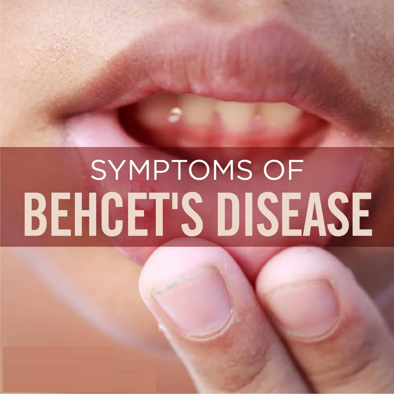BEHCET'S DISEASE SYMPTOMS