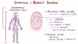 Behcet’s Disease: Symptoms, Causes, and Treatment Options