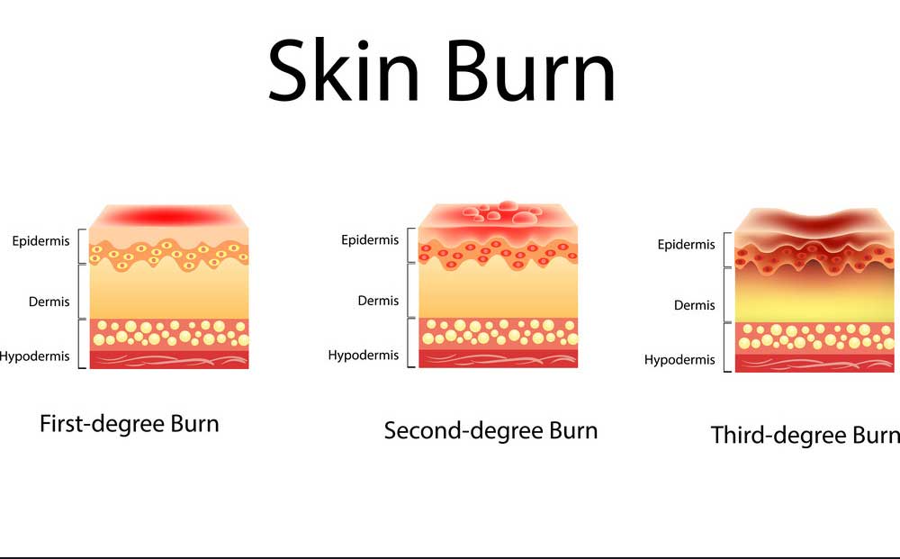 types of burns