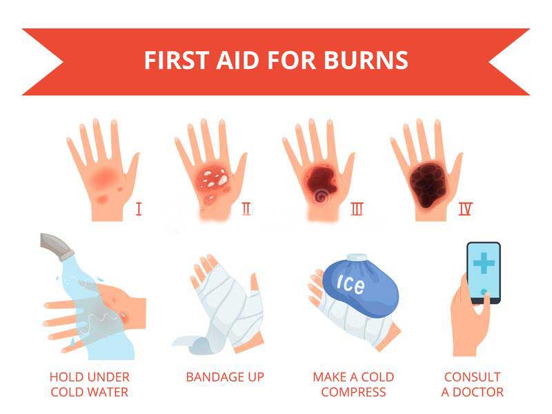 burns treatment