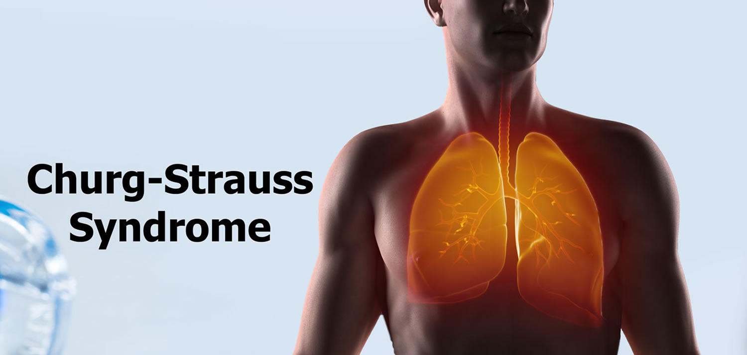 churg strauss syndrome