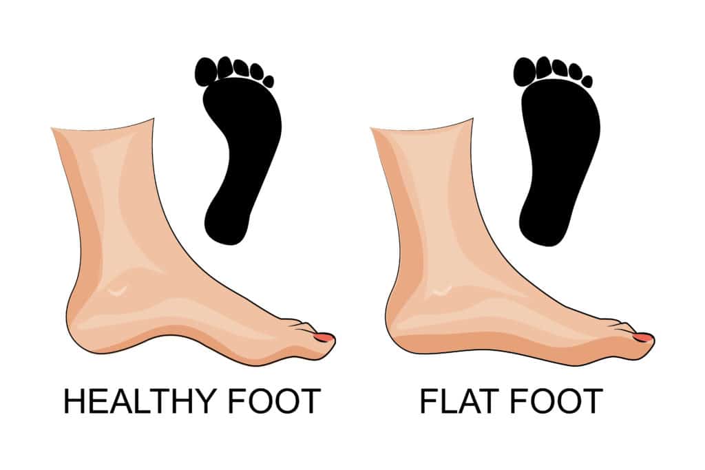 flat feet treatment