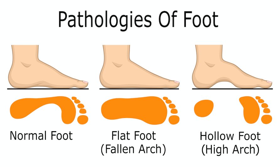 Pathologies of Foot