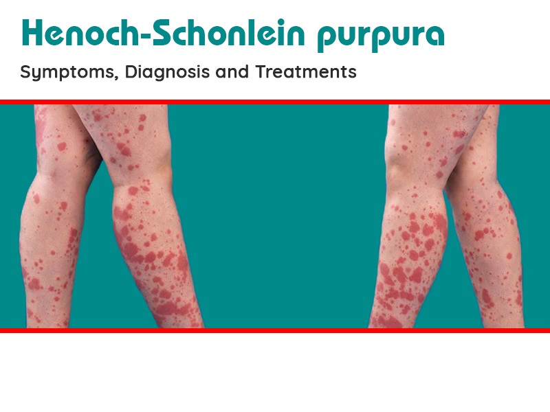 Henoch Schonlein Purpura: Symptoms, Causes, and Treatment