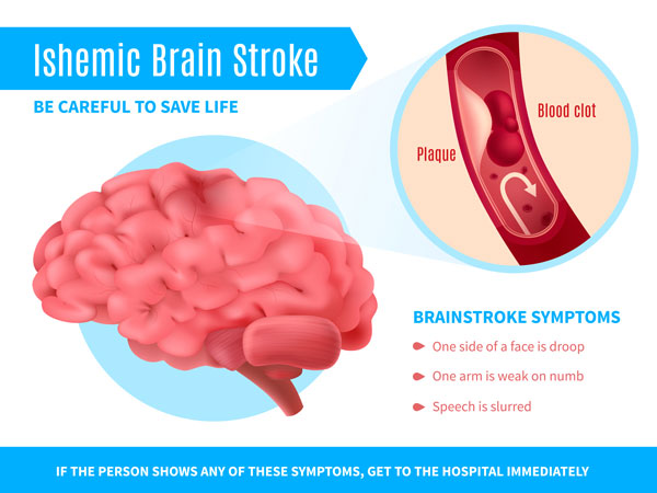 signs of a mini stroke