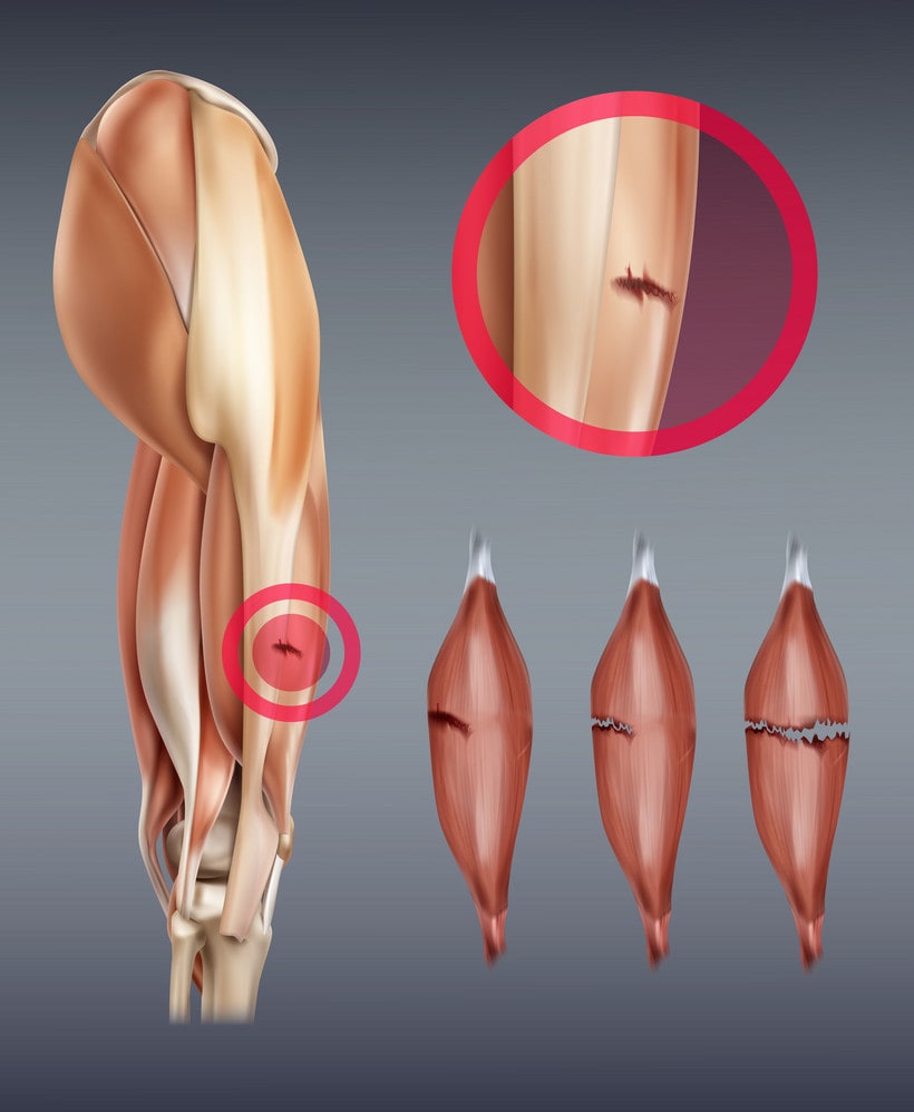 Leg muscle injury