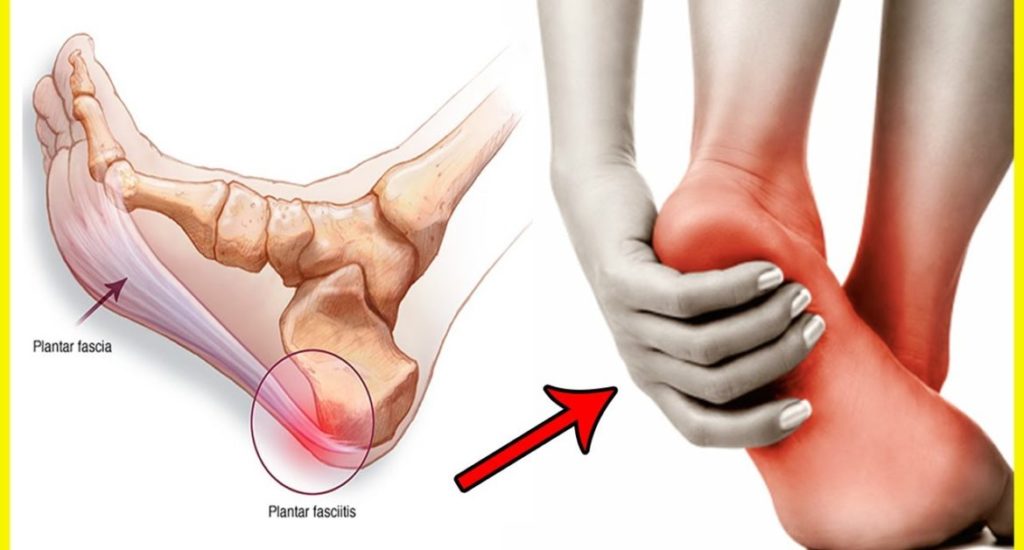 plantar fasciitis treatment