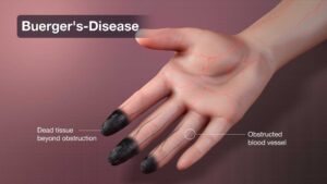 Buerger's Disease: Symptoms, Causes and Treatment