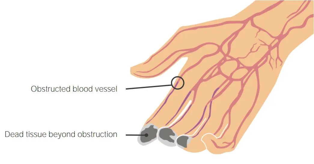 BUERGER'S DISEASE