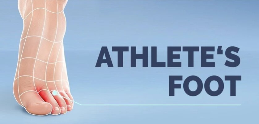 athlete's foot symptoms