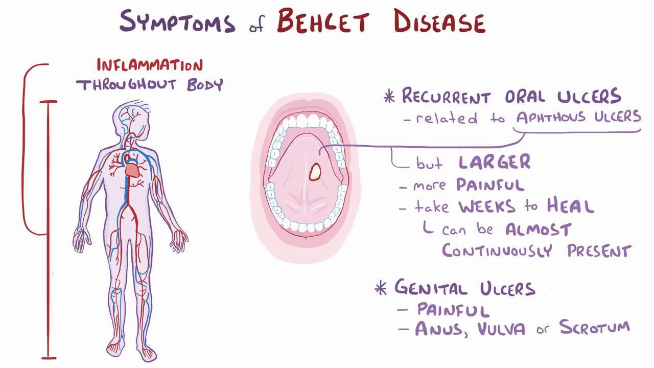 Behcet’s Disease: Symptoms, Causes, and Treatment Options