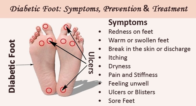 Diabetic Foot: Symptoms, Causes and Treatment 
