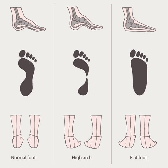 types of flat foot pain