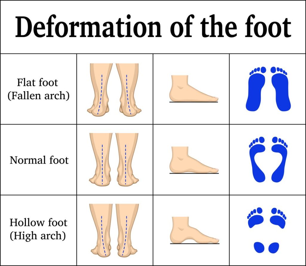 Deformation of flat foot pain