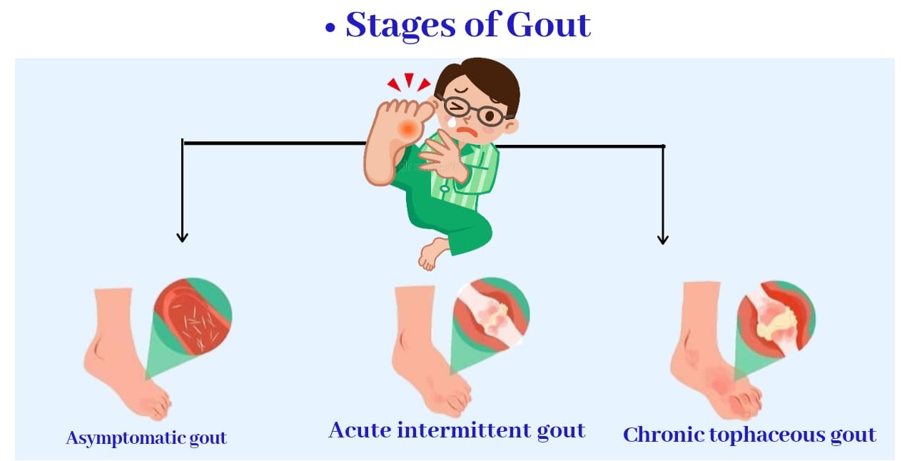 stage of gout