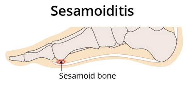 sesamoiditis treatment